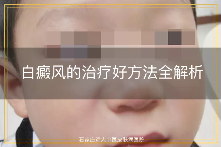 白癜风的治疗好方法全解析