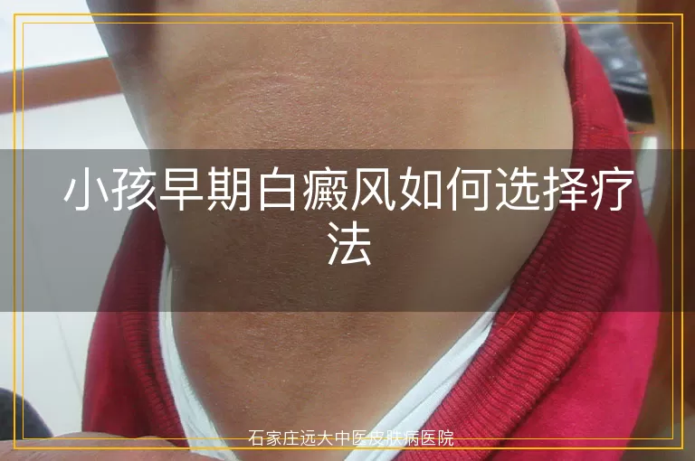 小孩早期白癜风如何选择疗法
