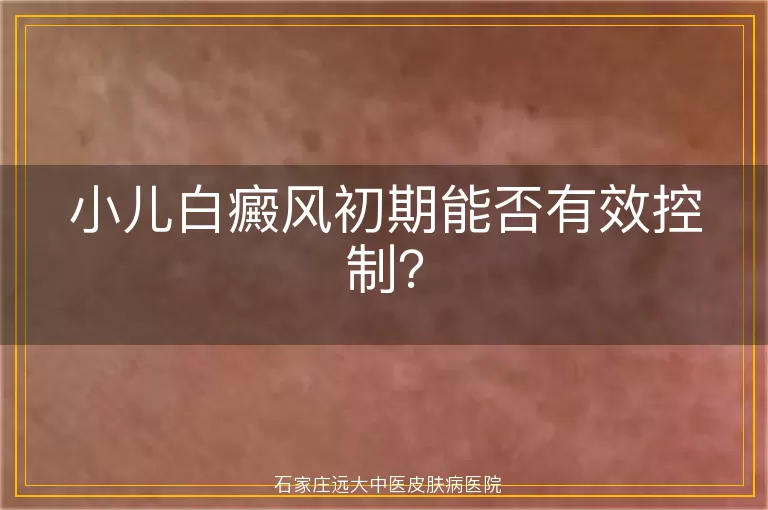 小儿白癜风初期能否有效控制？