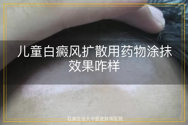 儿童白癜风扩散用药物涂抹效果咋样