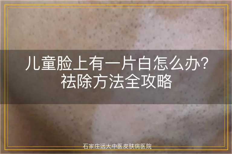 儿童脸上有一片白怎么办？祛除方法全攻略
