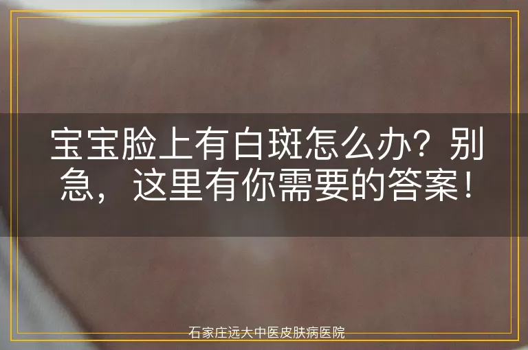 宝宝脸上有白斑怎么办？别急，这里有你需要的答案！