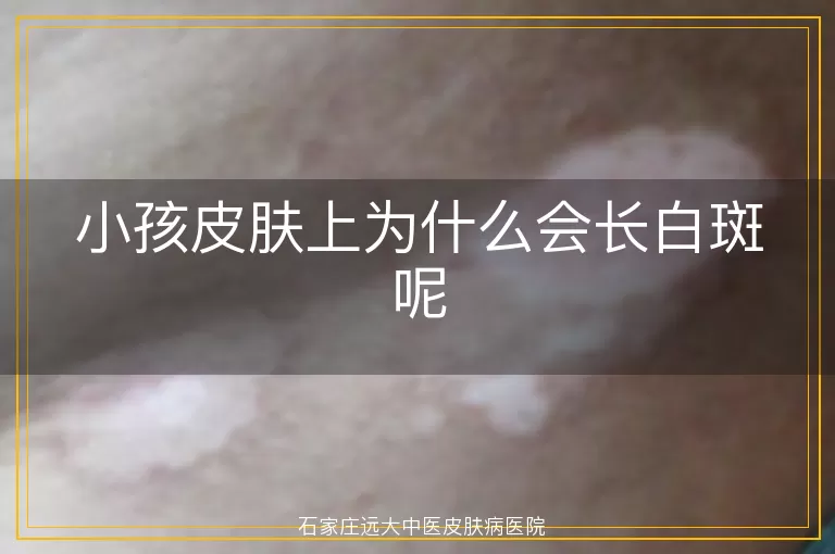 小孩皮肤上为什么会长白斑呢