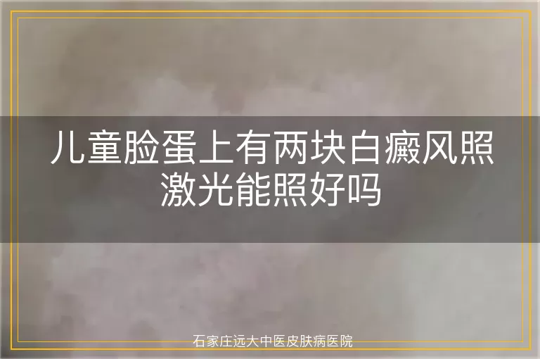 儿童脸蛋上有两块白癜风照激光能照好吗