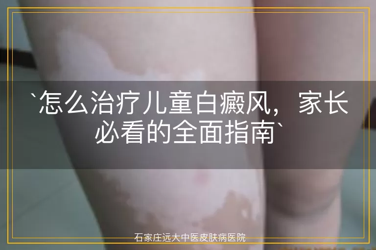 怎么治疗儿童白癜风，家长必看的全面指南