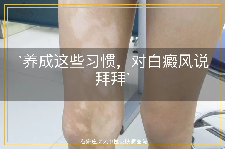 养成这些习惯，对白癜风说拜拜