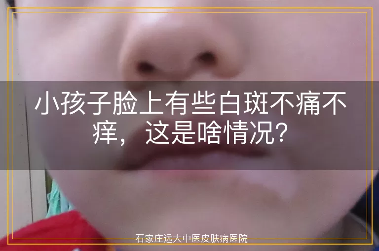 小孩子脸上有些白斑不痛不痒，这是啥情况？