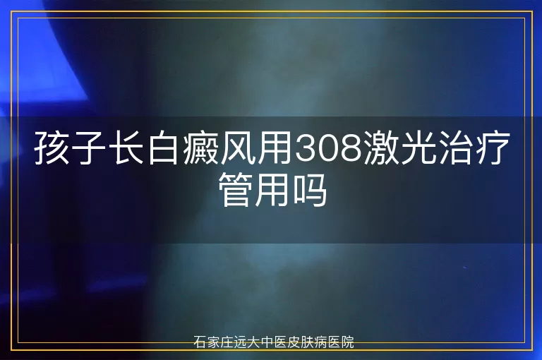 孩子长白癜风用308激光治疗管用吗