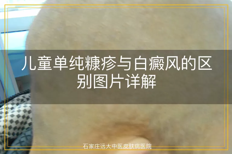 儿童单纯糠疹与白癜风的区别图片详解