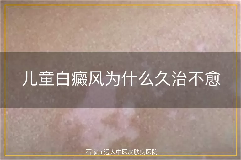 儿童白癜风为什么久治不愈