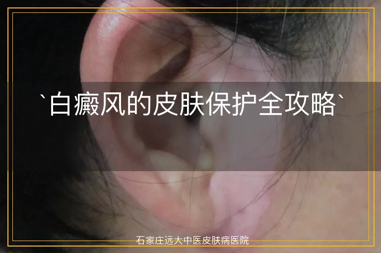 白癜风的皮肤保护全攻略