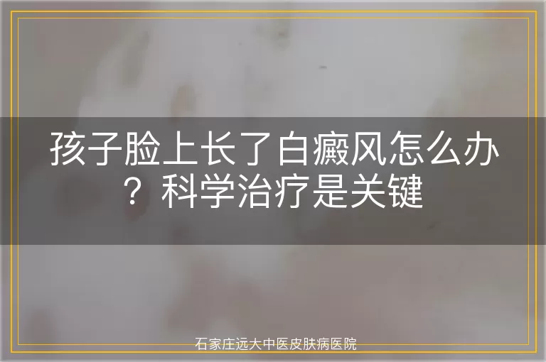 孩子脸上长了白癜风怎么办？科学治疗是关键