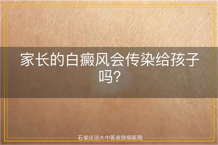 家长的白癜风会传染给孩子吗？