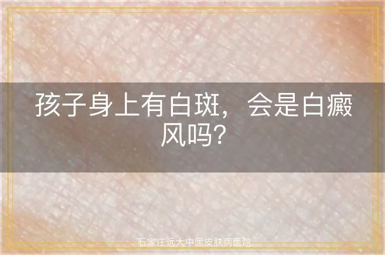 孩子身上有白斑，会是白癜风吗？