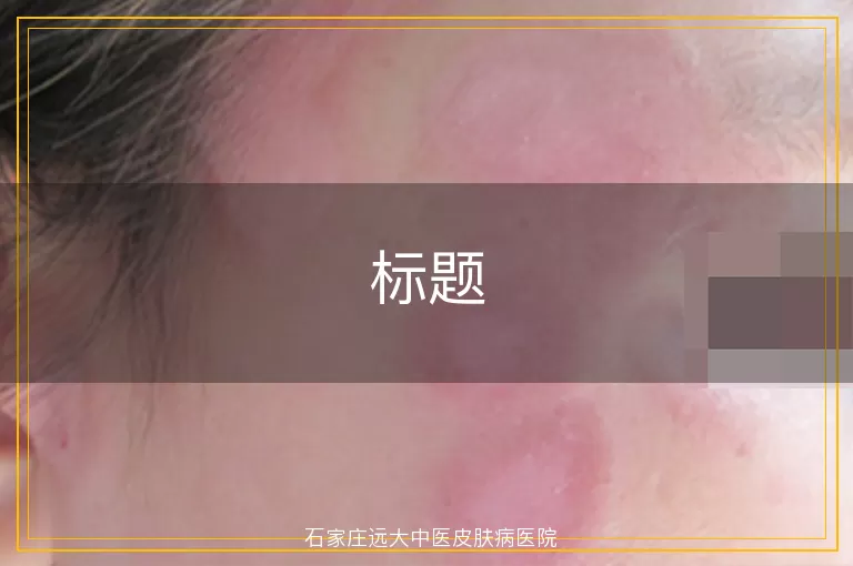 小孩嘴唇周围白癜风照光恢复慢吗