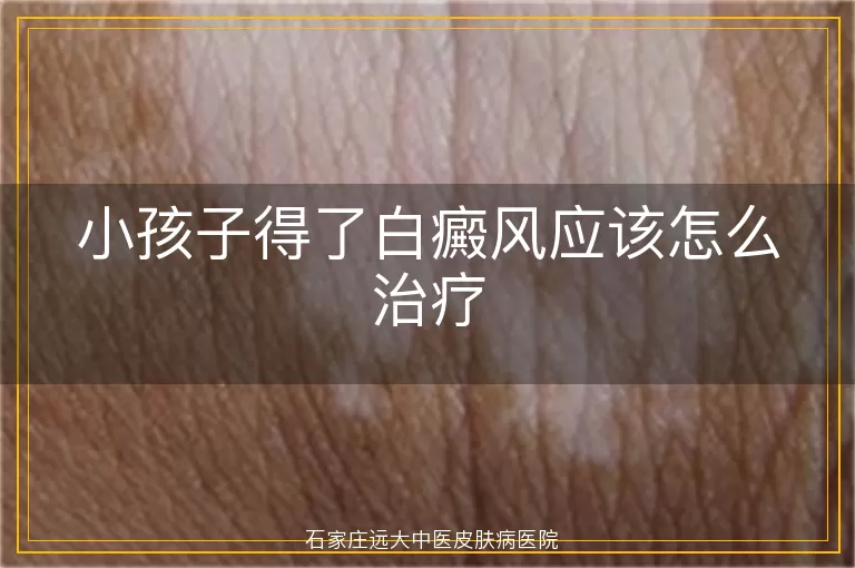 小孩子得了白癜风应该怎么治疗