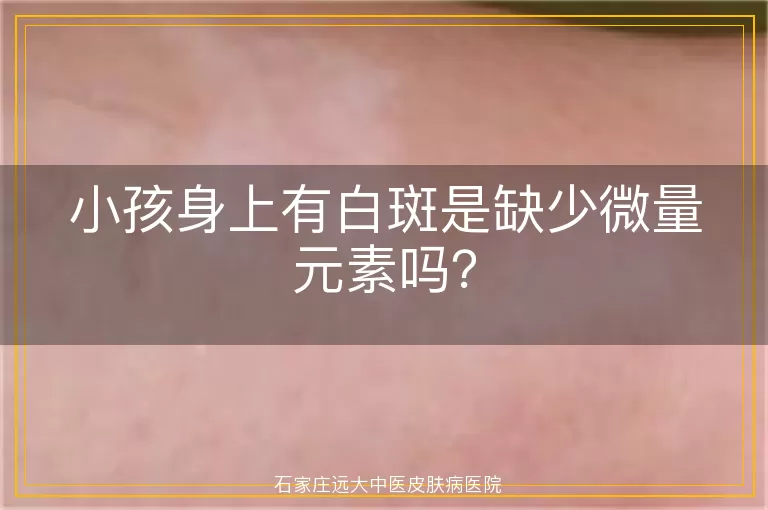 小孩身上有白斑是缺少微量元素吗？