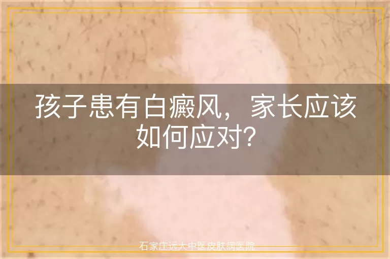 孩子患有白癜风，家长应该如何应对？