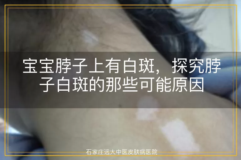 宝宝脖子上有白斑，探究脖子白斑的那些可能原因