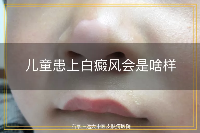 儿童患上白癜风会是啥样