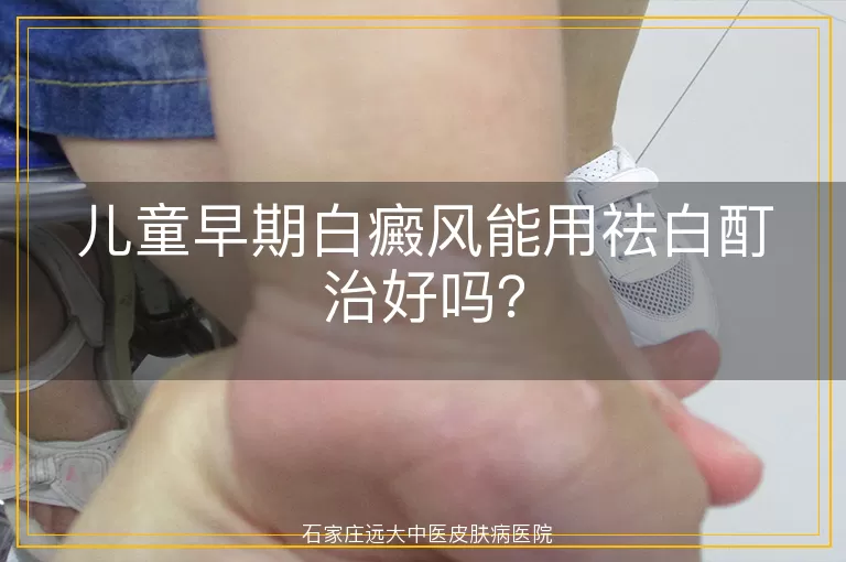 儿童早期白癜风能用祛白酊治好吗？
