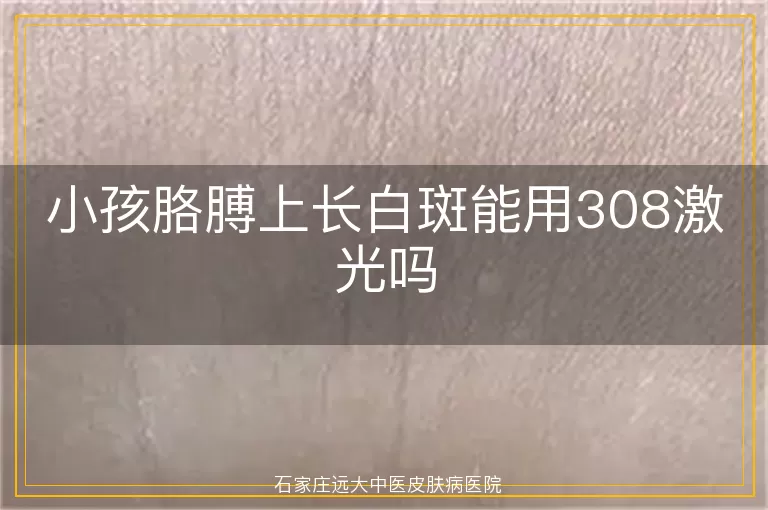 小孩胳膊上长白斑能用308激光吗