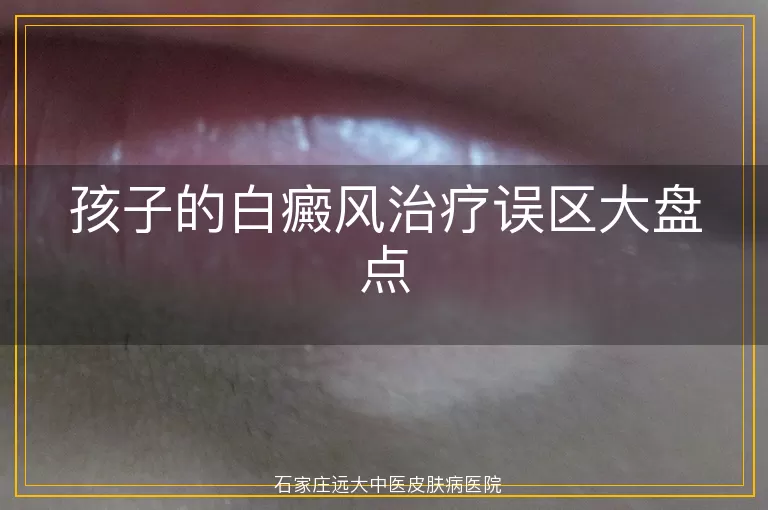 孩子的白癜风治疗误区大盘点