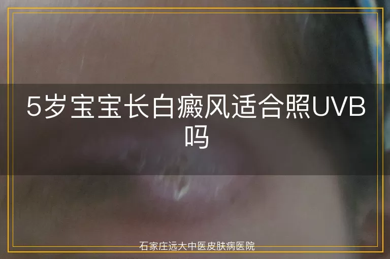 5岁宝宝长白癜风适合照UVB吗