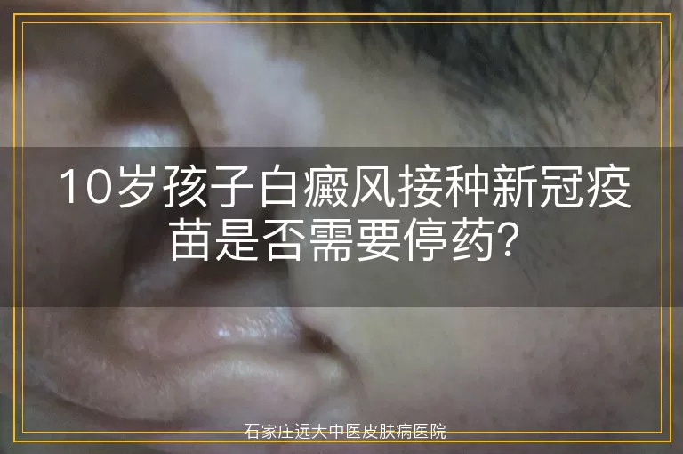 10岁孩子白癜风接种新冠疫苗是否需要停药？