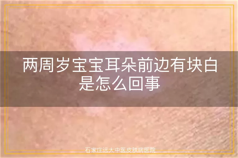 两周岁宝宝耳朵前边有块白是怎么回事
