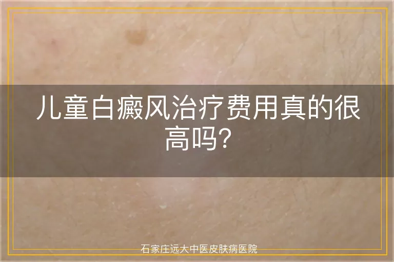 儿童白癜风治疗费用真的很高吗？