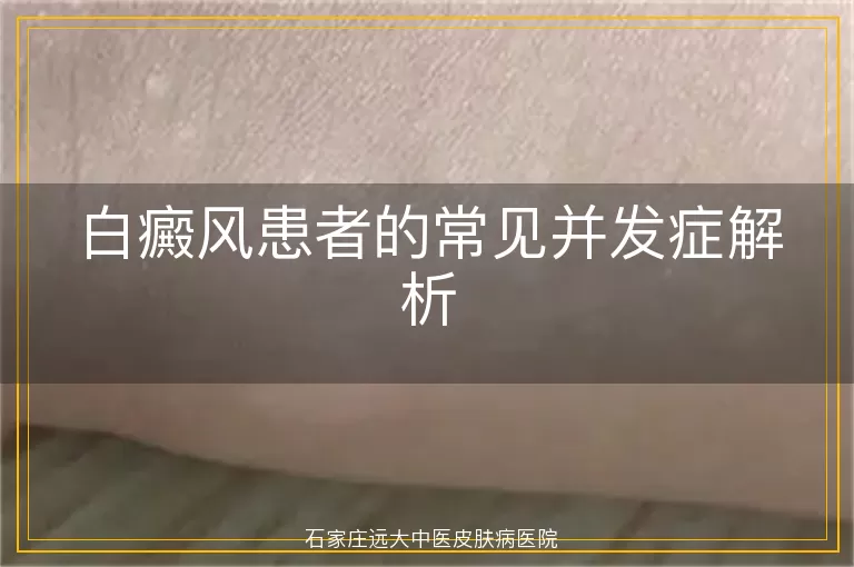 白癜风患者的常见并发症解析