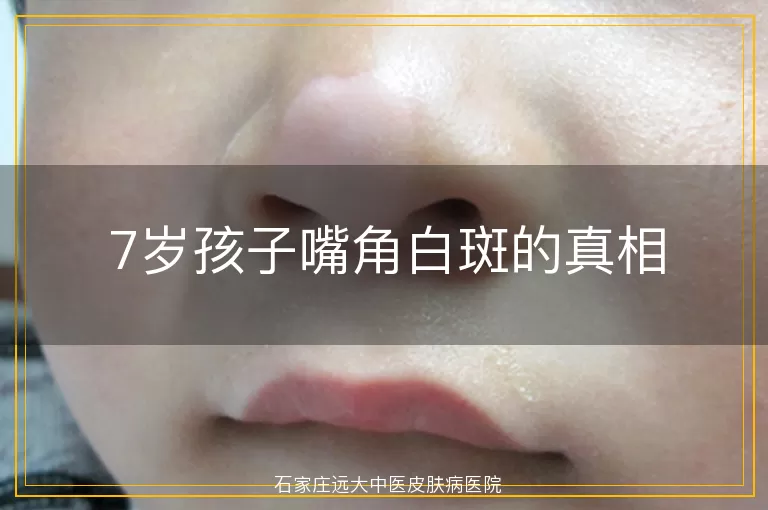 7岁孩子嘴角白斑的真相