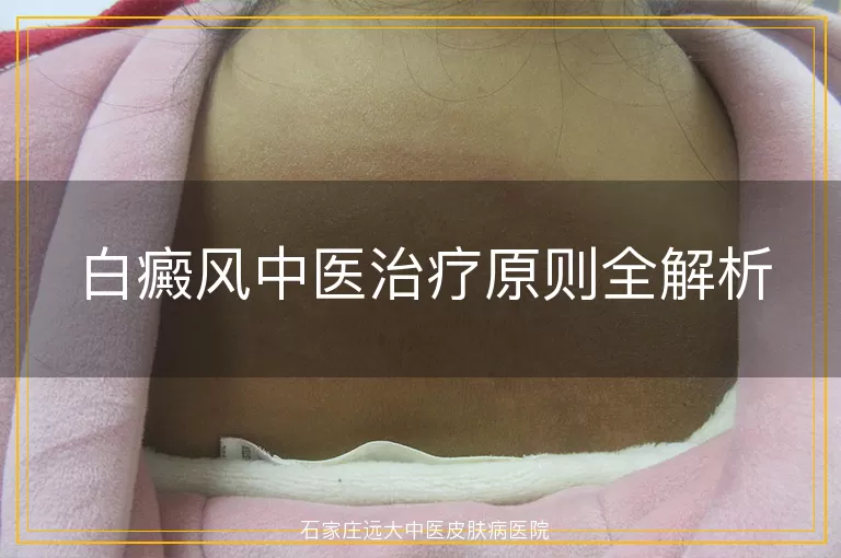 白癜风中医治疗原则全解析