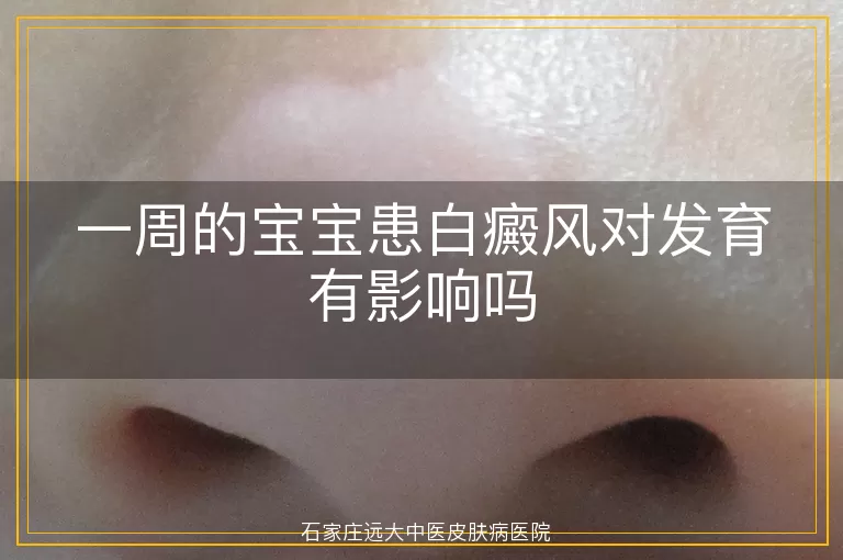 一周的宝宝患白癜风对发育有影响吗