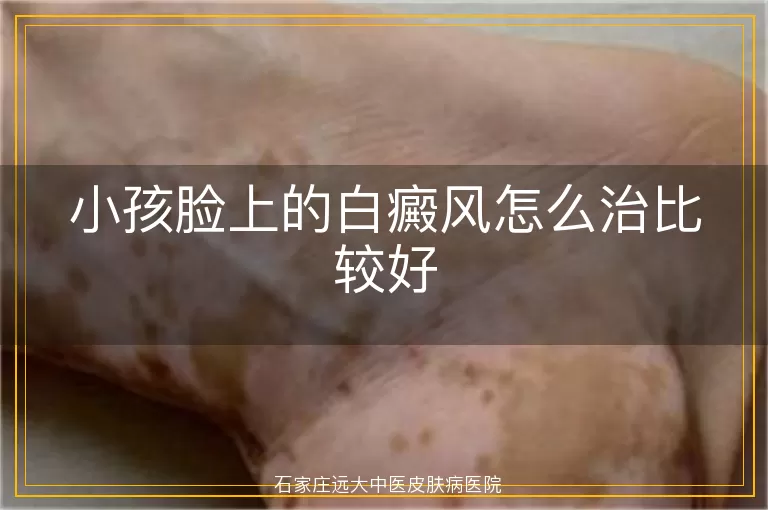 小孩脸上的白癜风怎么治比较好