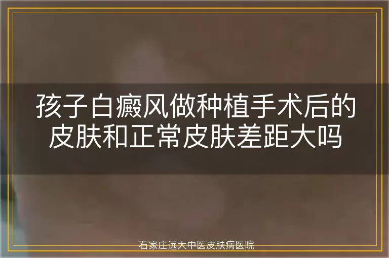 孩子白癜风做种植手术后的皮肤和正常皮肤差距大吗