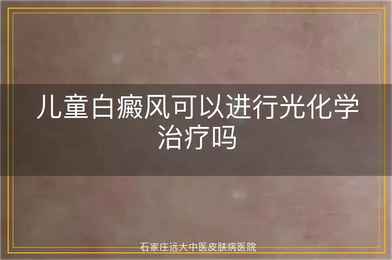 儿童白癜风可以进行光化学治疗吗
