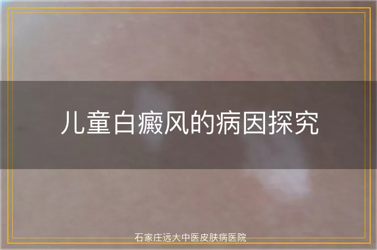 儿童白癜风的病因探究