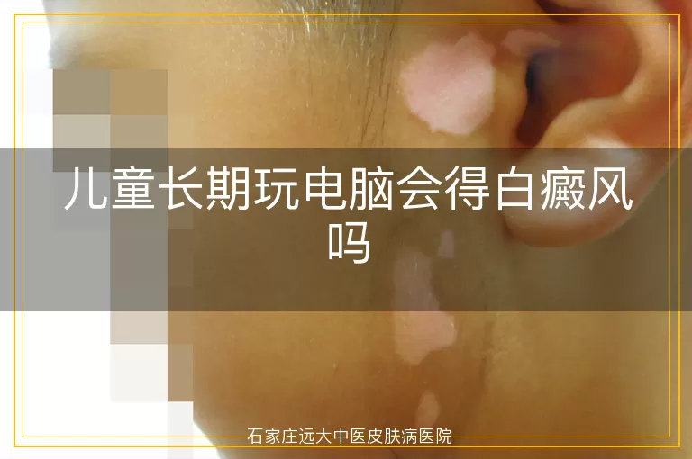 儿童长期玩电脑会得白癜风吗