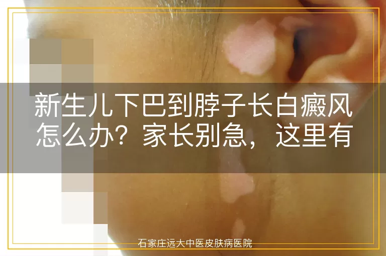 新生儿下巴到脖子长白癜风怎么办？家长别急，这里有应对方法