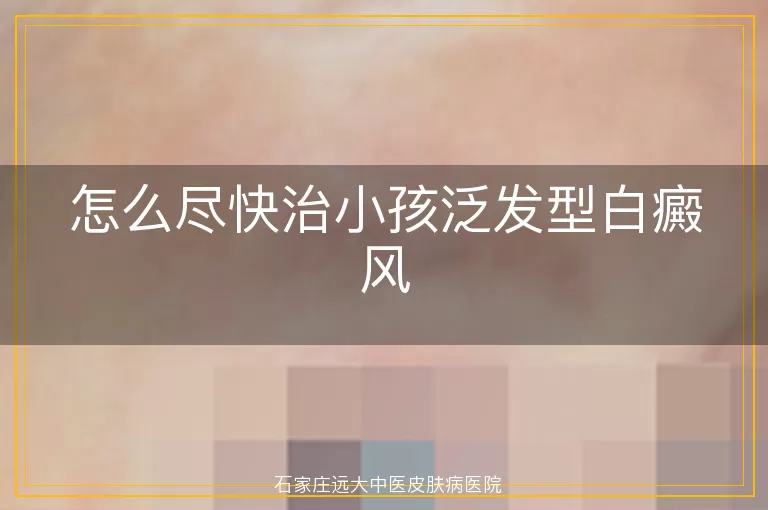 怎么尽快治小孩泛发型白癜风