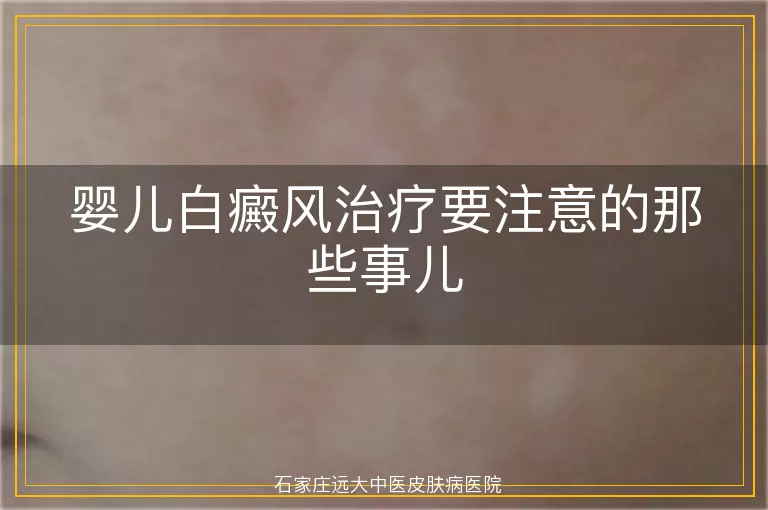 婴儿白癜风治疗要注意的那些事儿