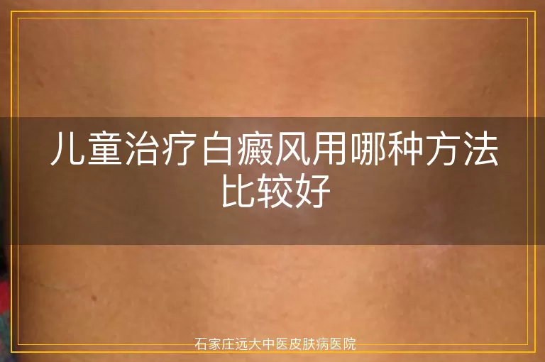 儿童治疗白癜风用哪种方法比较好