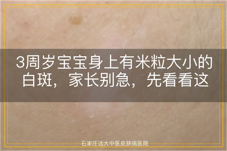 3周岁宝宝身上有米粒大小的白斑，家长别急，先看看这些可能的原因