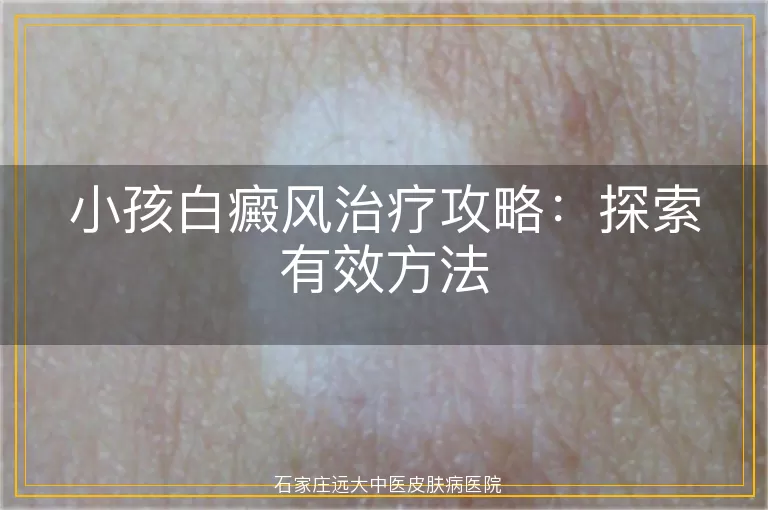 小孩白癜风治疗攻略：探索有效方法