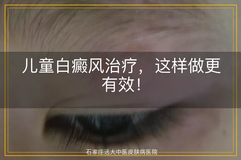 儿童白癜风治疗，这样做更有效！