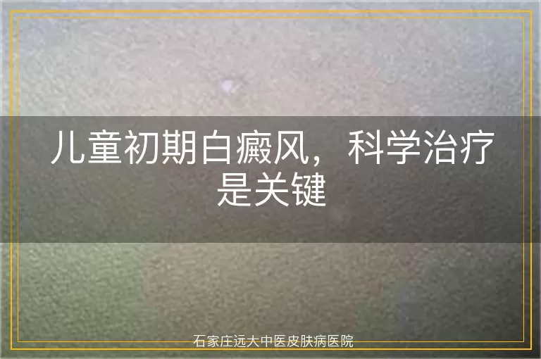 儿童初期白癜风，科学治疗是关键