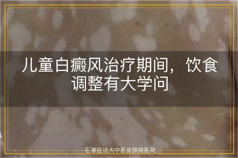 儿童白癜风治疗期间，饮食调整有大学问