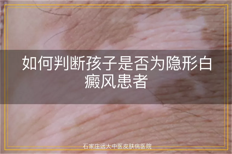 如何判断孩子是否为隐形白癜风患者